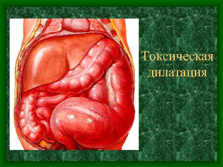 Токсическая дилатация 