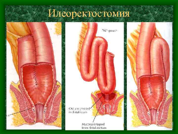 Илеоректостомия 