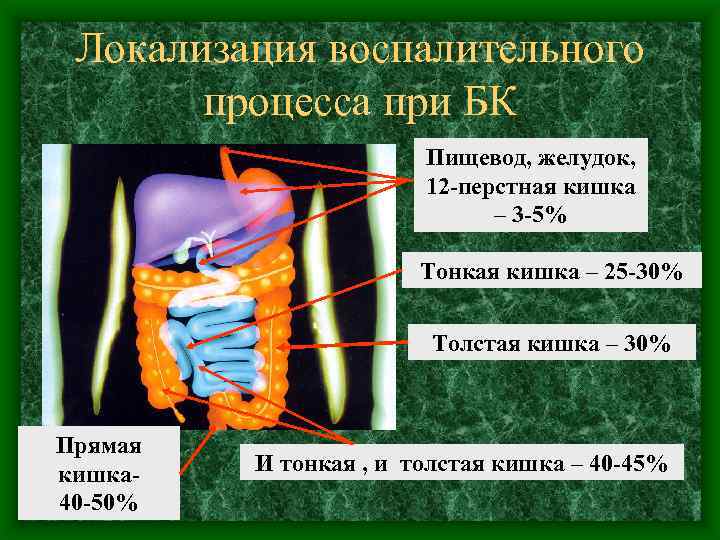 Локализация воспалительного процесса при БК Пищевод, желудок, 12 -перстная кишка – 3 -5% Тонкая