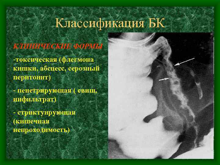 Классификация БК КЛИНИЧЕСКИЕ ФОРМЫ -токсическая (флегмона кишки, абсцесс, серозный перитонит) - пенетрирующая ( свищ,