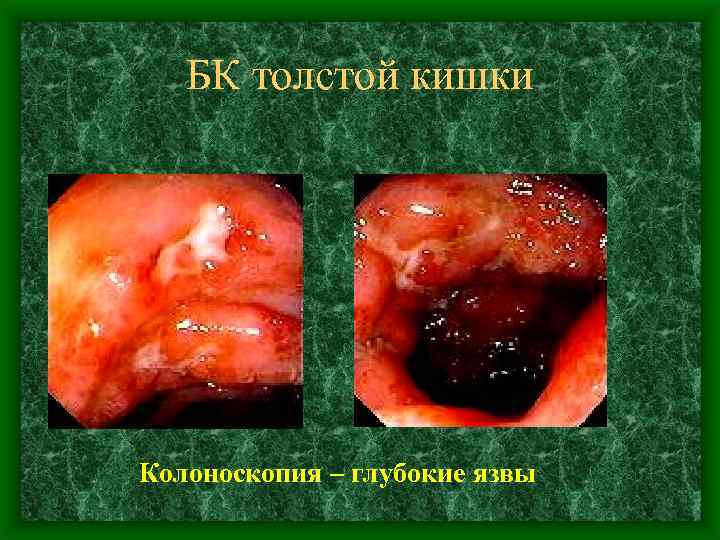 БК толстой кишки Колоноскопия – глубокие язвы 