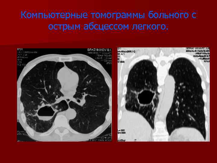 Компьютерные томограммы больного с острым абсцессом легкого. 