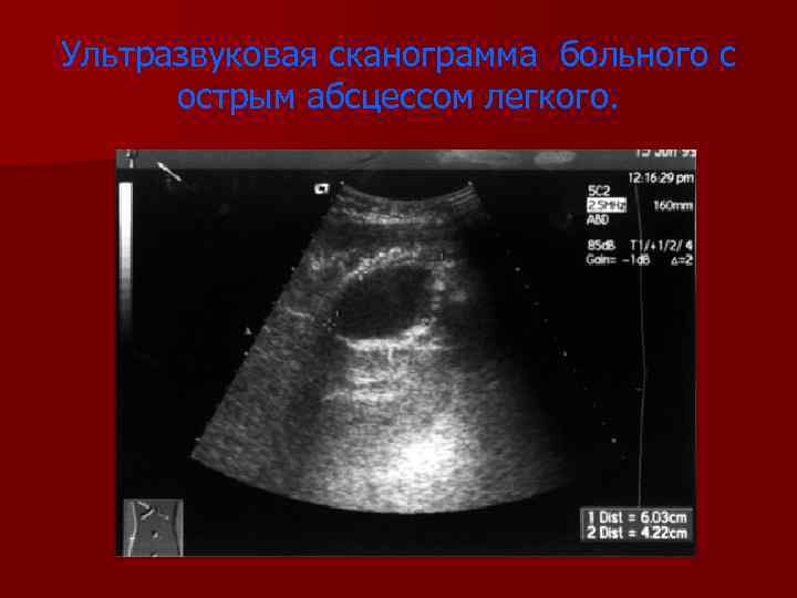 Ультразвуковая сканограмма больного с острым абсцессом легкого. 