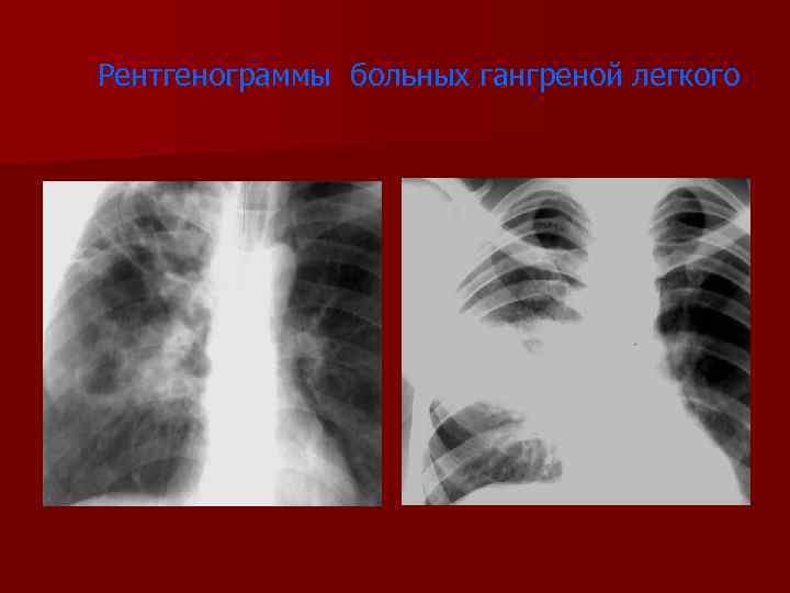 Рентгенограммы больных гангреной легкого 