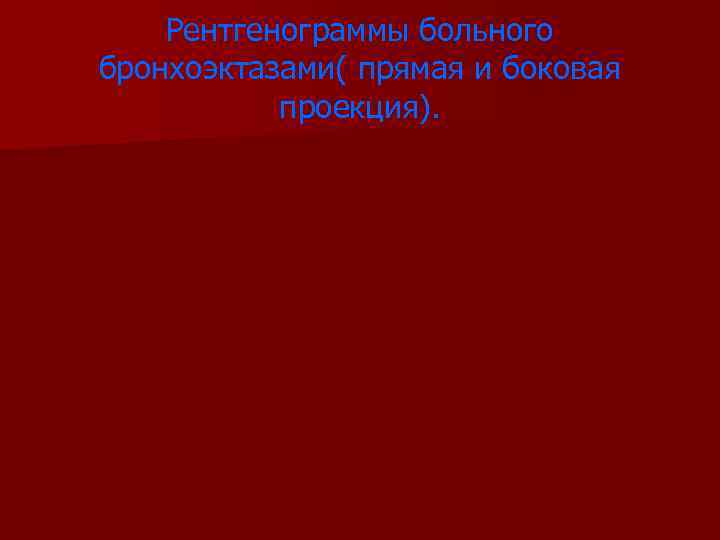 Рентгенограммы больного бронхоэктазами( прямая и боковая проекция). 