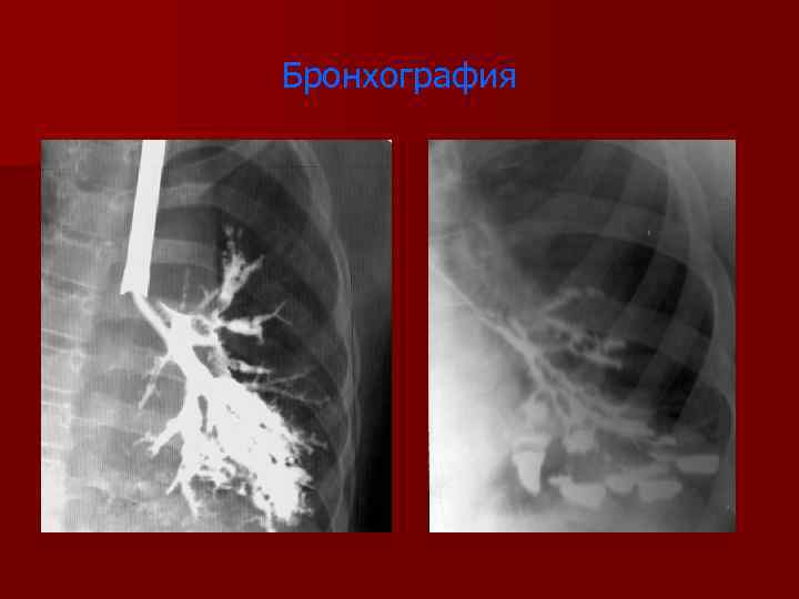 Бронхография 