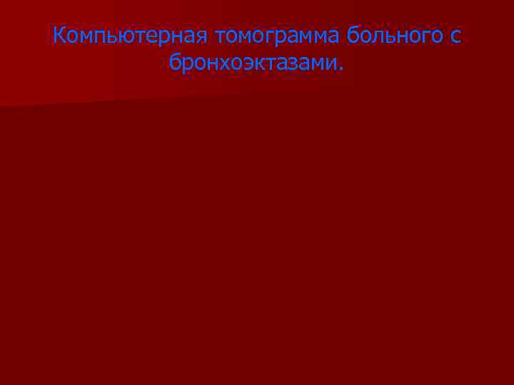 Компьютерная томограмма больного с бронхоэктазами. 
