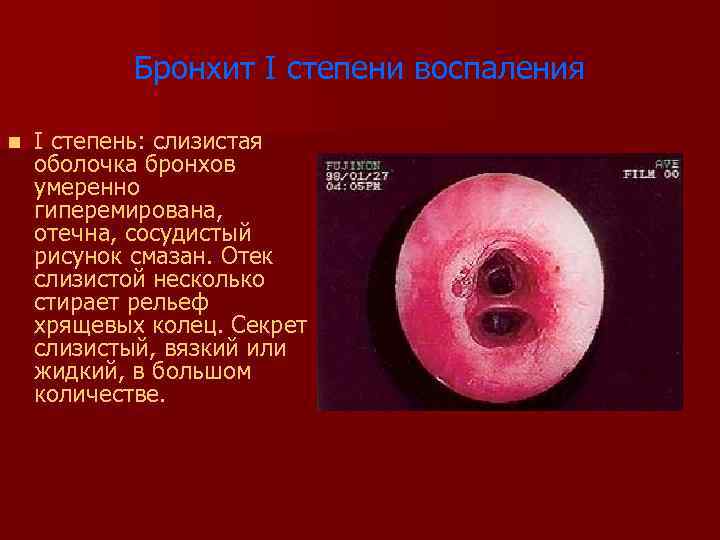 Бронхит I степени воспаления n I степень: слизистая оболочка бронхов умеренно гиперемирована, отечна, сосудистый