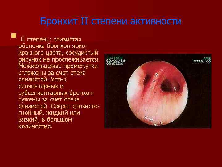 Бронхит II степени активности § II степень: слизистая оболочка бронхов яркокрасного цвета, сосудистый рисунок