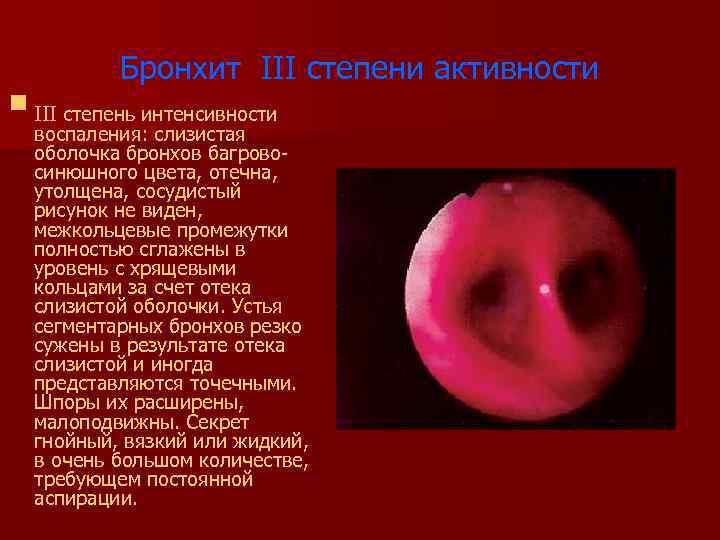 § Бронхит III степени активности III степень интенсивности воспаления: слизистая оболочка бронхов багровосинюшного цвета,