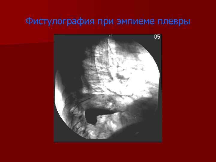 Фистулография при эмпиеме плевры 