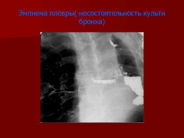 Эмпиема плевры( несостоятельность культи бронха) 