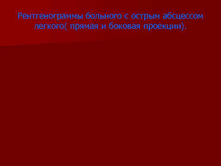 Рентгенограммы больного с острым абсцессом легкого( прямая и боковая проекции). 