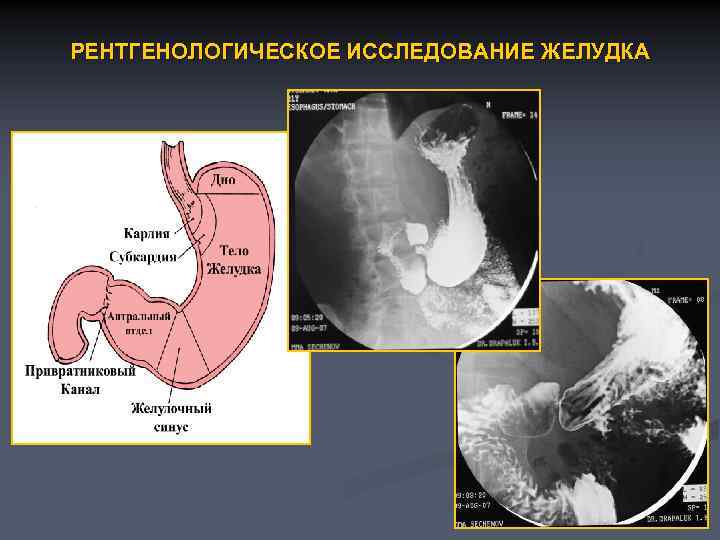 РЕНТГЕНОЛОГИЧЕСКОЕ ИССЛЕДОВАНИЕ ЖЕЛУДКА 