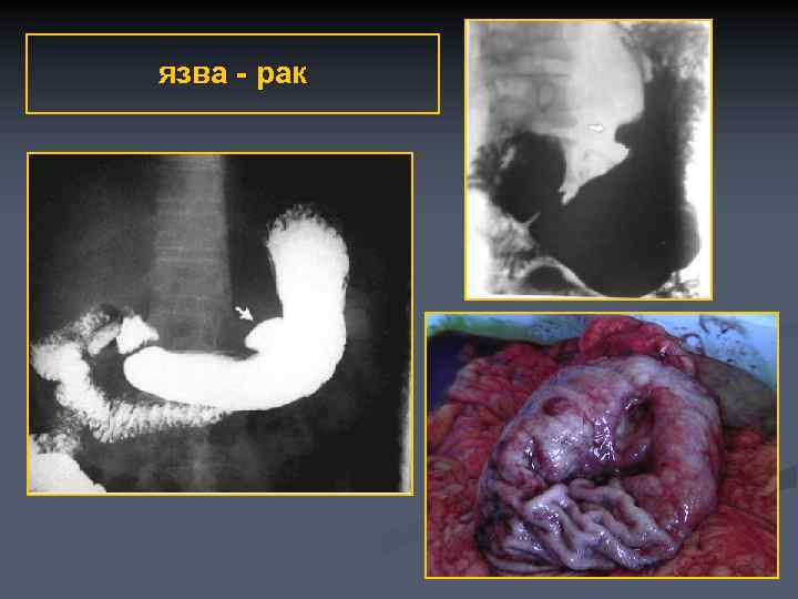 язва - рак 