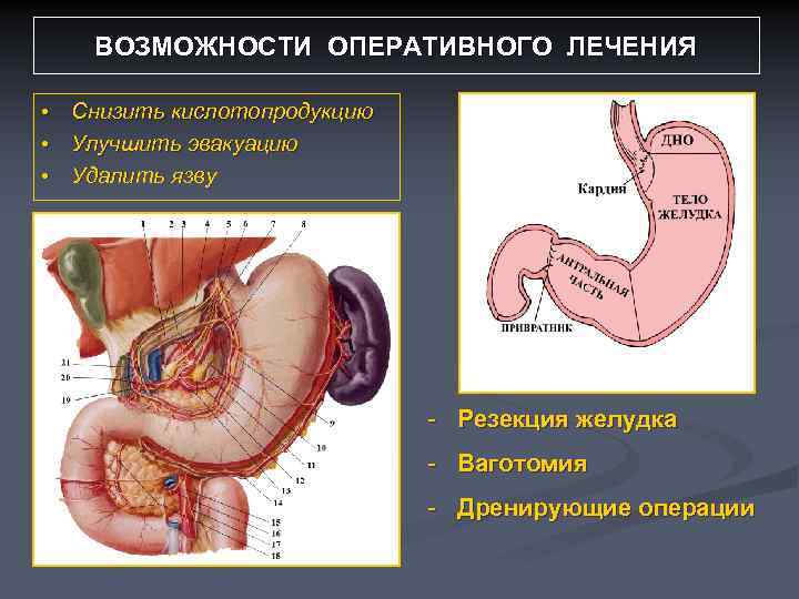 ВОЗМОЖНОСТИ ОПЕРАТИВНОГО ЛЕЧЕНИЯ Снизить кислотопродукцию • Улучшить эвакуацию • Удалить язву • - Резекция