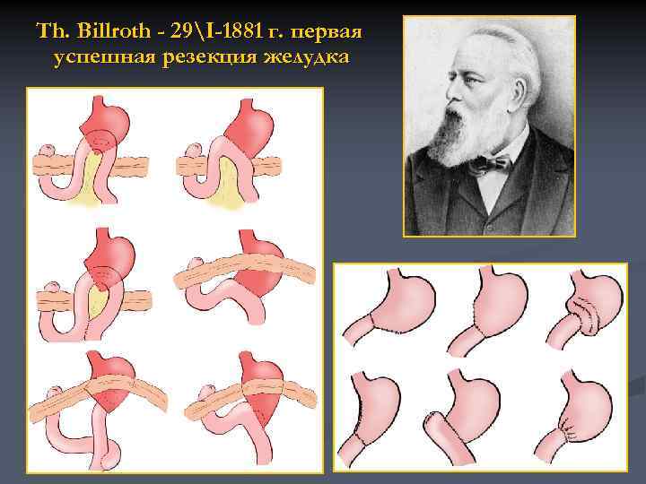 Th. Billroth - 29I-1881 г. первая успешная резекция желудка 