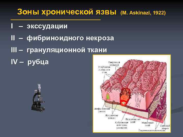 Зоны хронической язвы I – экссудации II – фибриноидного некроза III – грануляционной ткани