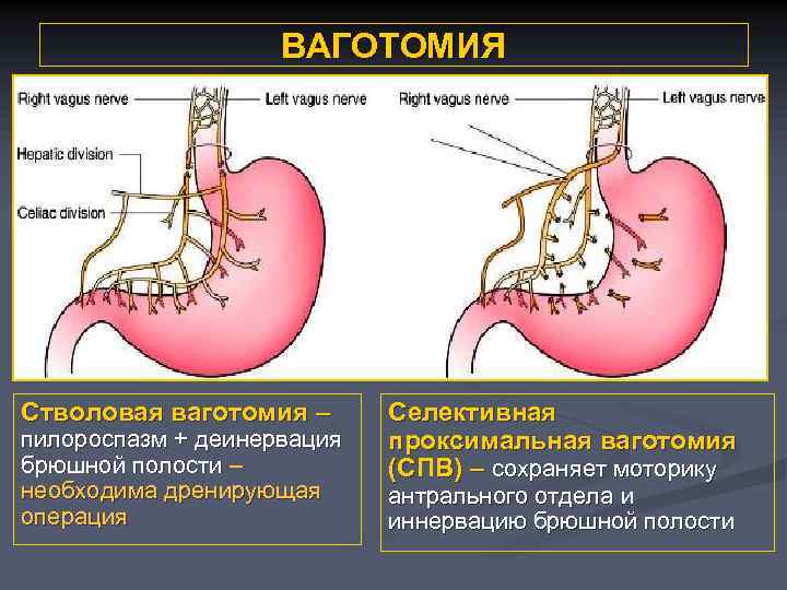 ВАГОТОМИЯ Стволовая ваготомия – пилороспазм + деинервация брюшной полости – необходима дренирующая операция Селективная