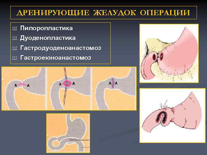 ДРЕНИРУЮЩИЕ ЖЕЛУДОК ОПЕРАЦИИ Ш Пилоропластика Ш Дуоденопластика Ш Гастродуоденоанастомоз Ш Гастроеюноанастомоз 