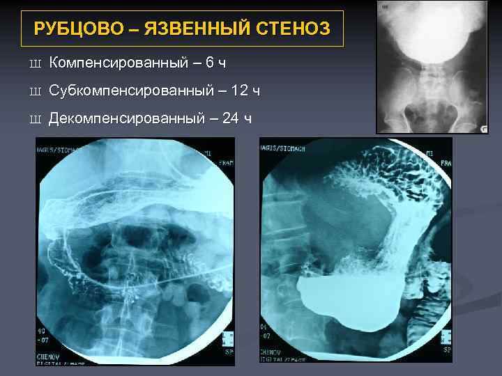 РУБЦОВО – ЯЗВЕННЫЙ СТЕНОЗ Ш Компенсированный – 6 ч Ш Субкомпенсированный – 12 ч