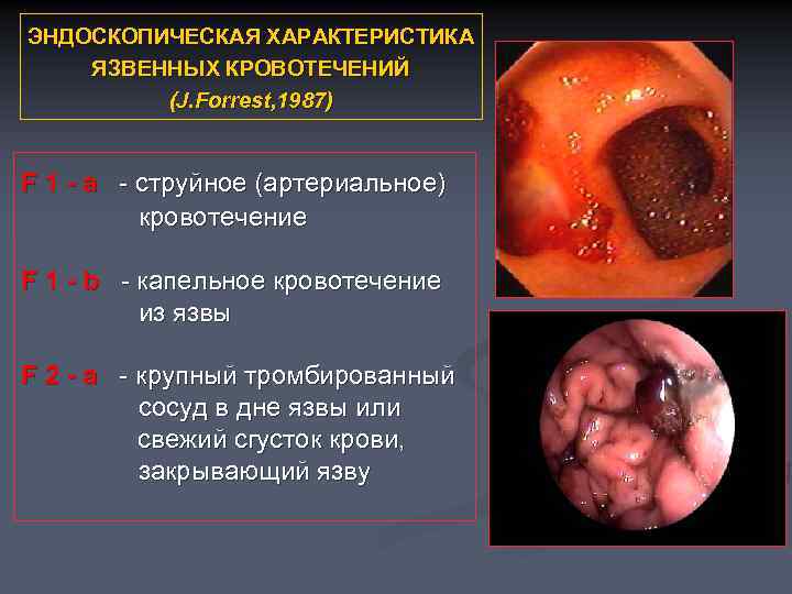 ЭНДОСКОПИЧЕСКАЯ ХАРАКТЕРИСТИКА ЯЗВЕННЫХ КРОВОТЕЧЕНИЙ (J. Forrest, 1987) F 1 - а - струйное (артериальное)