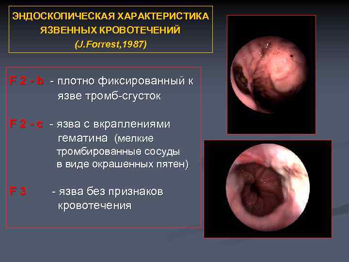 ЭНДОСКОПИЧЕСКАЯ ХАРАКТЕРИСТИКА ЯЗВЕННЫХ КРОВОТЕЧЕНИЙ (J. Forrest, 1987) F 2 - b - плотно фиксированный