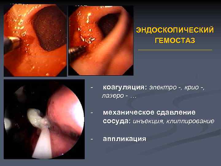 ЭНДОСКОПИЧЕСКИЙ ГЕМОСТАЗ - коагуляция: электро -, крио -, лазеро - … - механическое сдавление