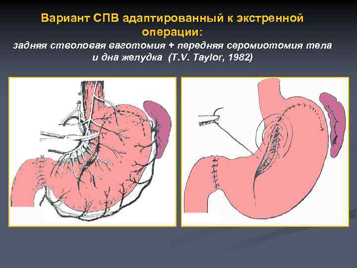 Вариант СПВ адаптированный к экстренной операции: задняя стволовая ваготомия + передняя серомиотомия тела и