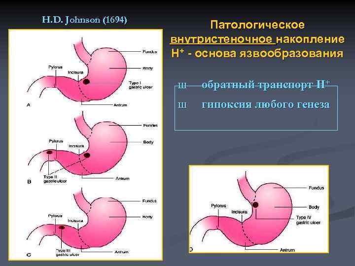 H. D. Johnson (1694) Патологическое внутристеночное накопление Н+ - основа язвообразования Ш обратный транспорт