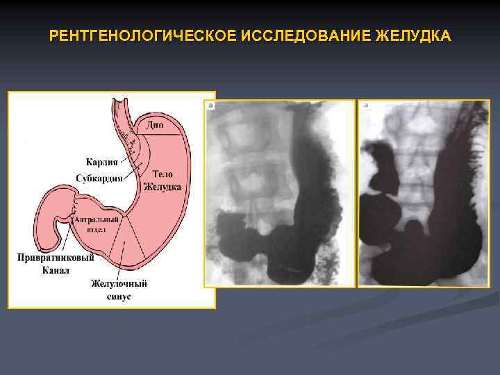 РЕНТГЕНОЛОГИЧЕСКОЕ ИССЛЕДОВАНИЕ ЖЕЛУДКА 