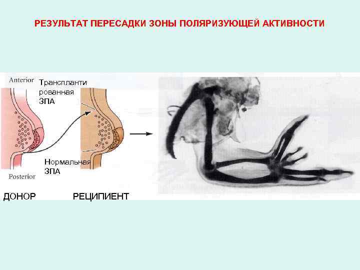 РЕЗУЛЬТАТ ПЕРЕСАДКИ ЗОНЫ ПОЛЯРИЗУЮЩЕЙ АКТИВНОСТИ Транспланти рованная ЗПА Нормальная ЗПА ДОНОР РЕЦИПИЕНТ 