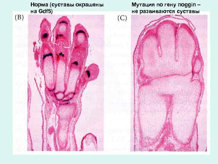 Норма (суставы окрашены на Gdf 5) Мутация по гену noggin – не развиваются суставы