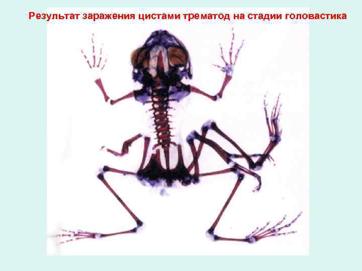 Результат заражения цистами трематод на стадии головастика 
