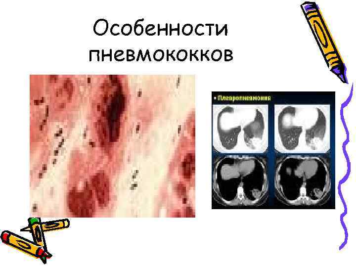 Особенности пневмококков 