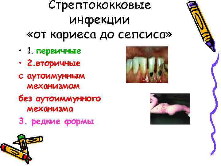 Стрептококковые инфекции «от кариеса до сепсиса» • 1. первичные • 2. вторичные с аутоимунным