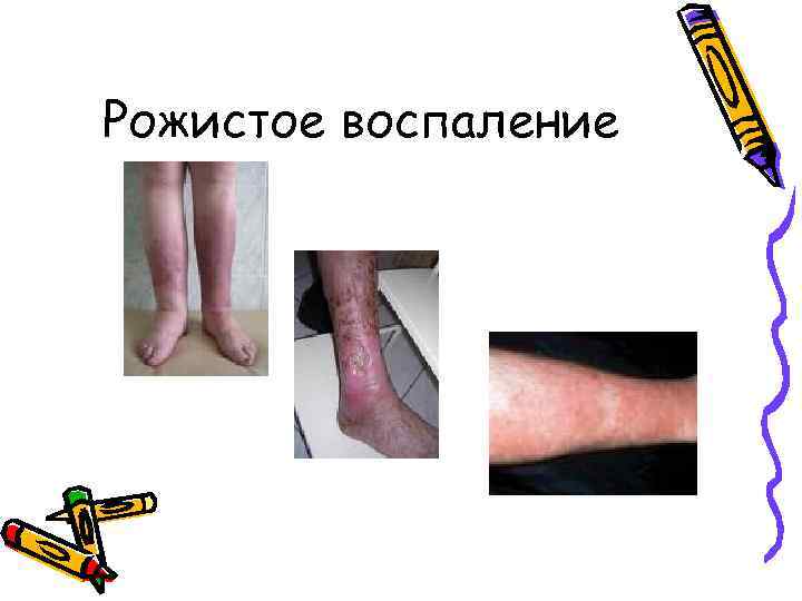 Рожистое воспаление 