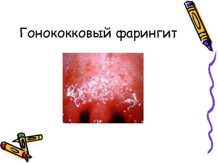 Гонококковый фарингит 