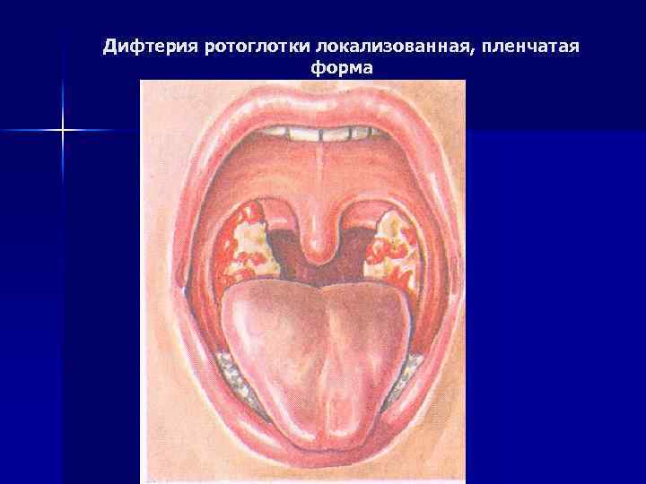 Дифтерия ротоглотки локализованная, пленчатая форма 