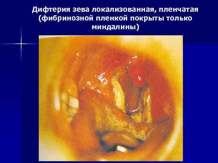 Дифтерия зева локализованная, пленчатая (фибринозной пленкой покрыты только миндалины) 