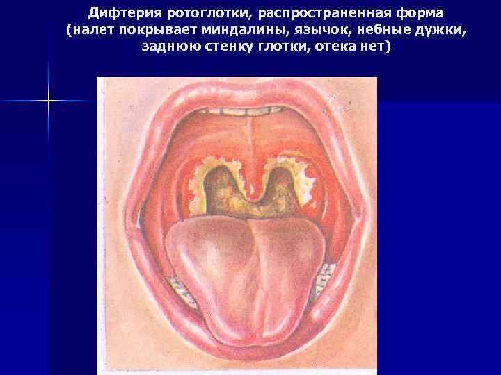 Дифтерия ротоглотки, распространенная форма (налет покрывает миндалины, язычок, небные дужки, заднюю стенку глотки, отека