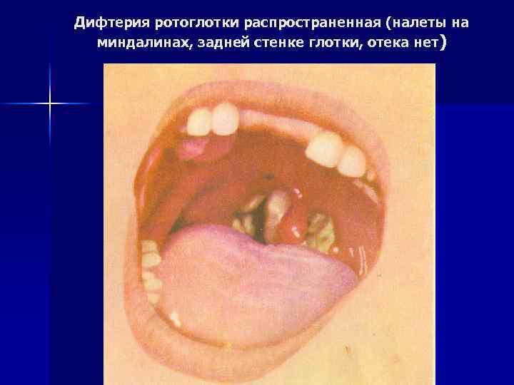 Дифтерия ротоглотки распространенная (налеты на миндалинах, задней стенке глотки, отека нет) 