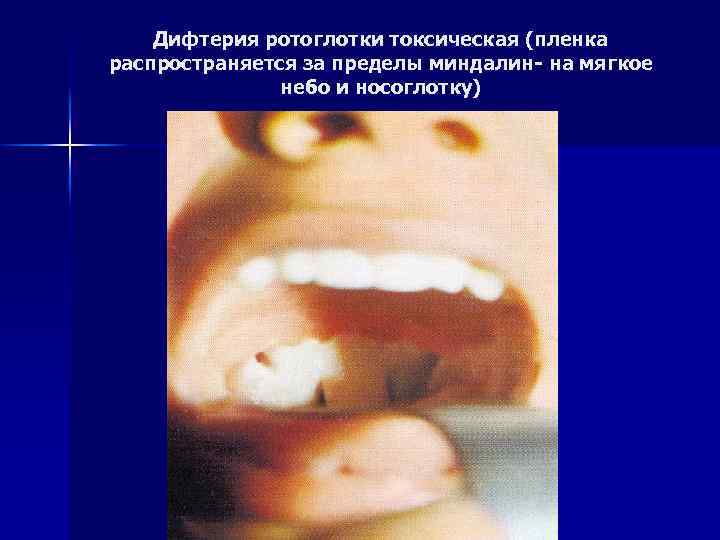 Дифтерия ротоглотки токсическая (пленка распространяется за пределы миндалин- на мягкое небо и носоглотку) 