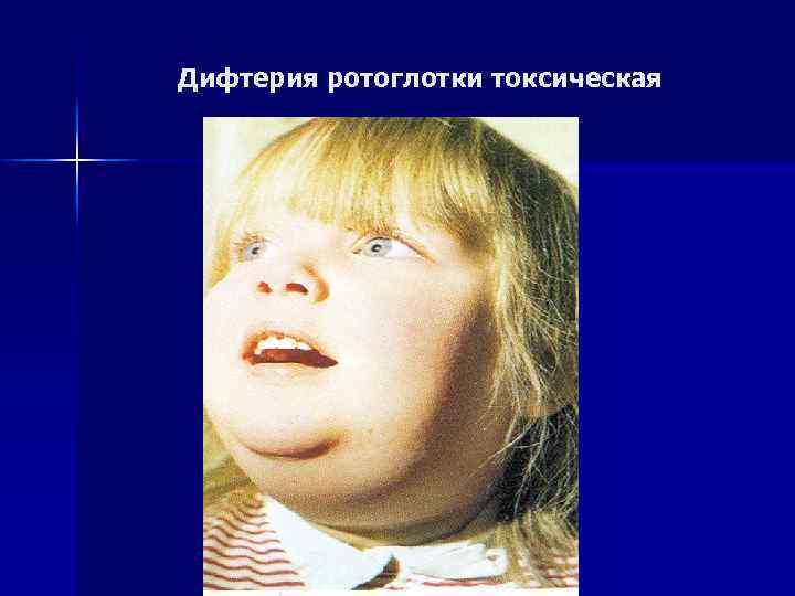 Дифтерия ротоглотки токсическая 