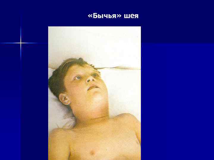  «Бычья» шея 