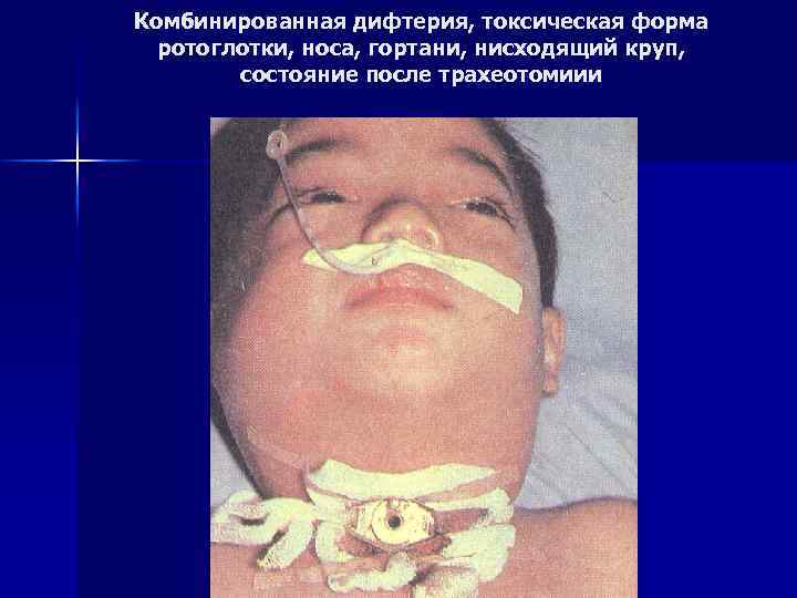 Комбинированная дифтерия, токсическая форма ротоглотки, носа, гортани, нисходящий круп, состояние после трахеотомиии 