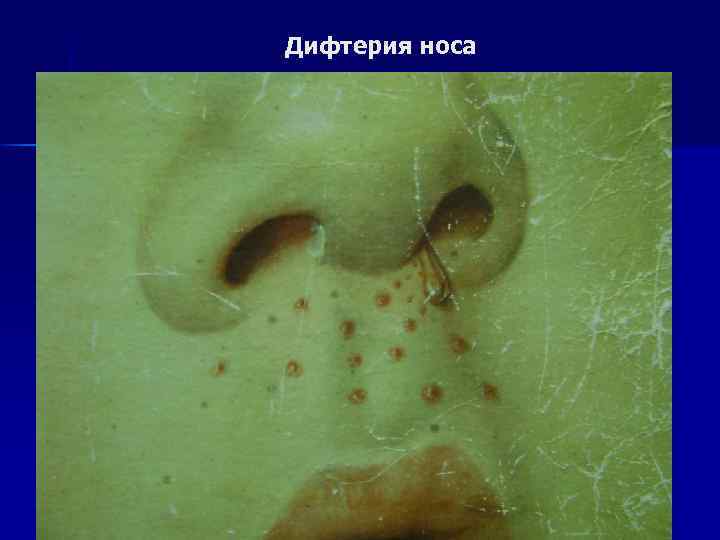 Дифтерия носа 