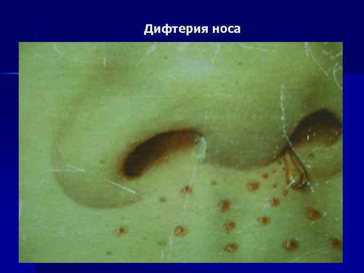 Дифтерия носа 