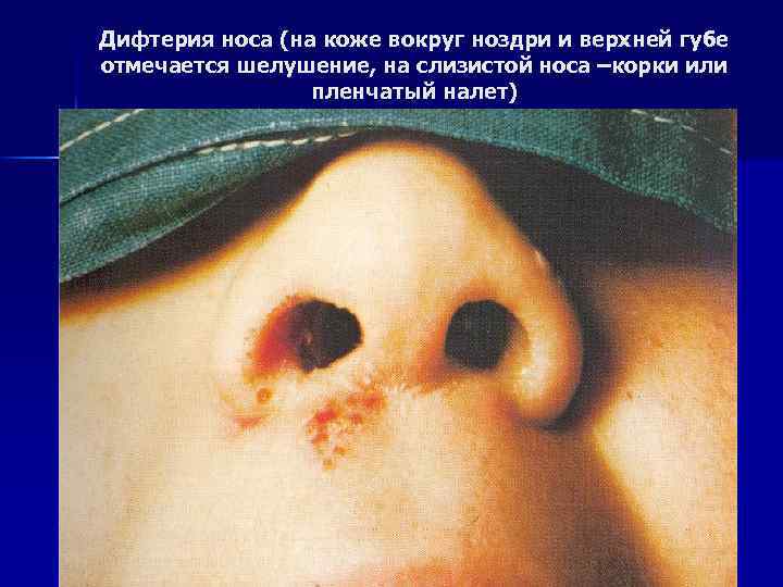 Дифтерия носа (на коже вокруг ноздри и верхней губе отмечается шелушение, на слизистой носа