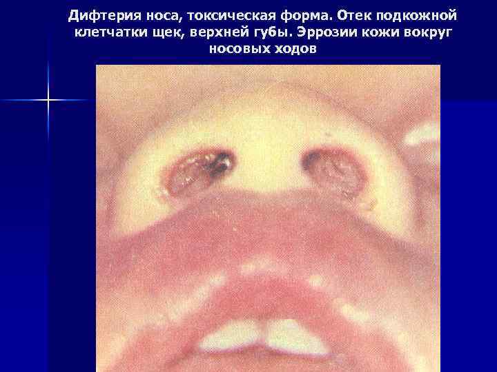 Дифтерия носа, токсическая форма. Отек подкожной клетчатки щек, верхней губы. Эррозии кожи вокруг носовых
